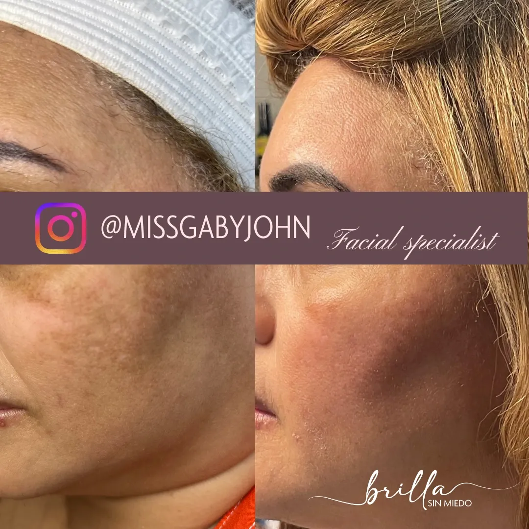 Antes y después: Dermapen con Vitaminas en Brilla Sin Miedo, caso 1