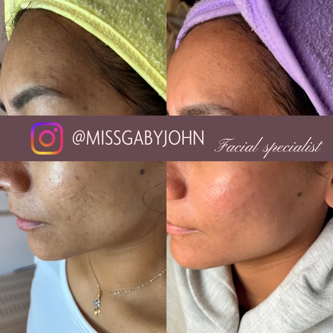 Antes y después: Dermapen con Vitaminas en Brilla Sin Miedo, caso 2