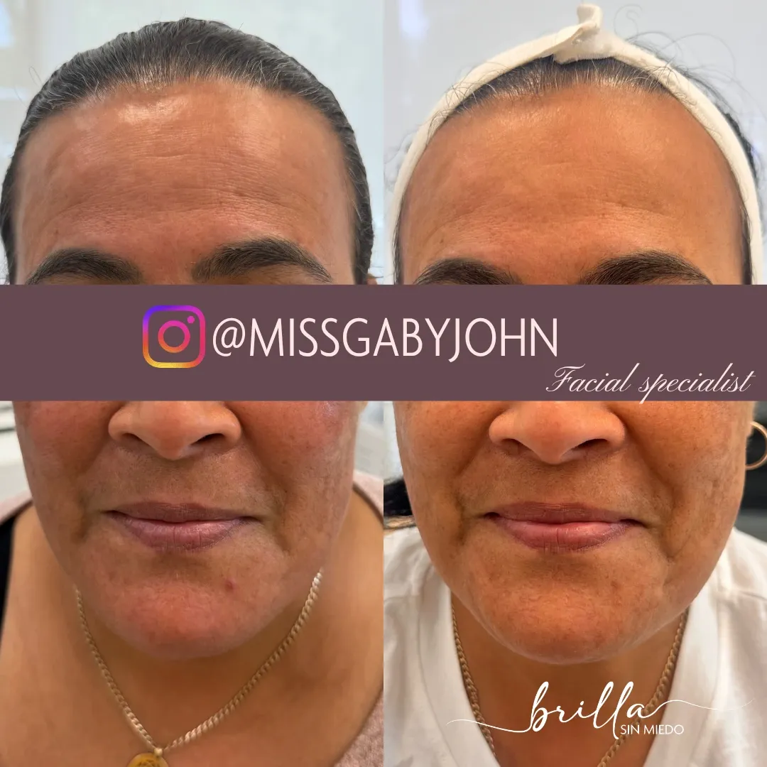 Antes y después: Dermapen con Vitaminas en Brilla Sin Miedo, caso 3