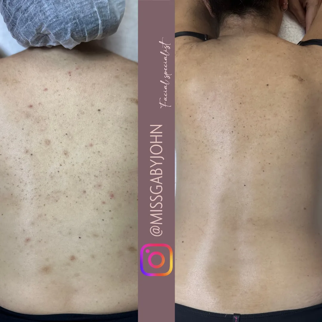 Antes y después: Peeling Facial y Corporal en Brilla Sin Miedo, caso 1