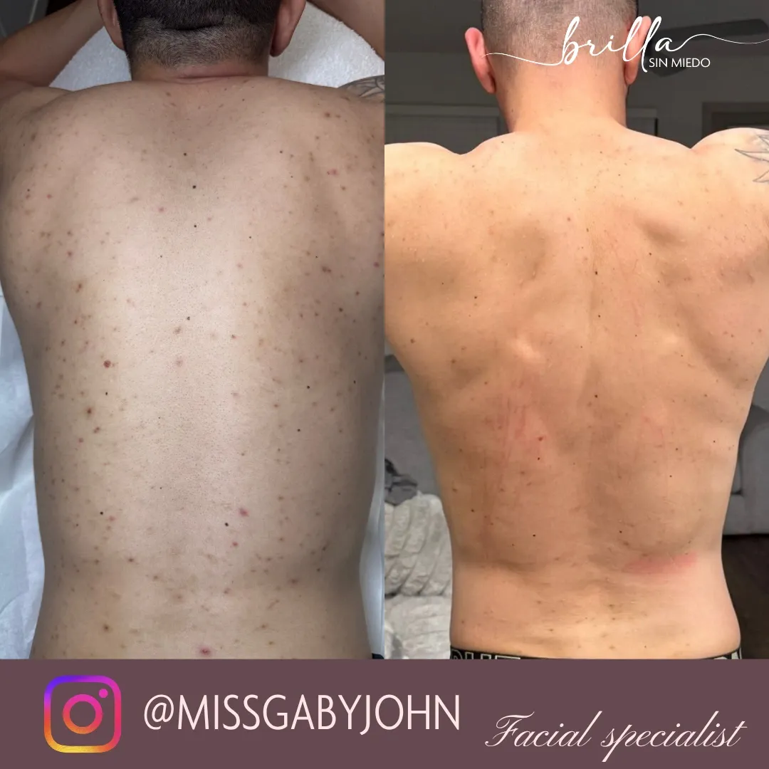 Antes y después: Peeling Facial y Corporal en Brilla Sin Miedo, caso 2