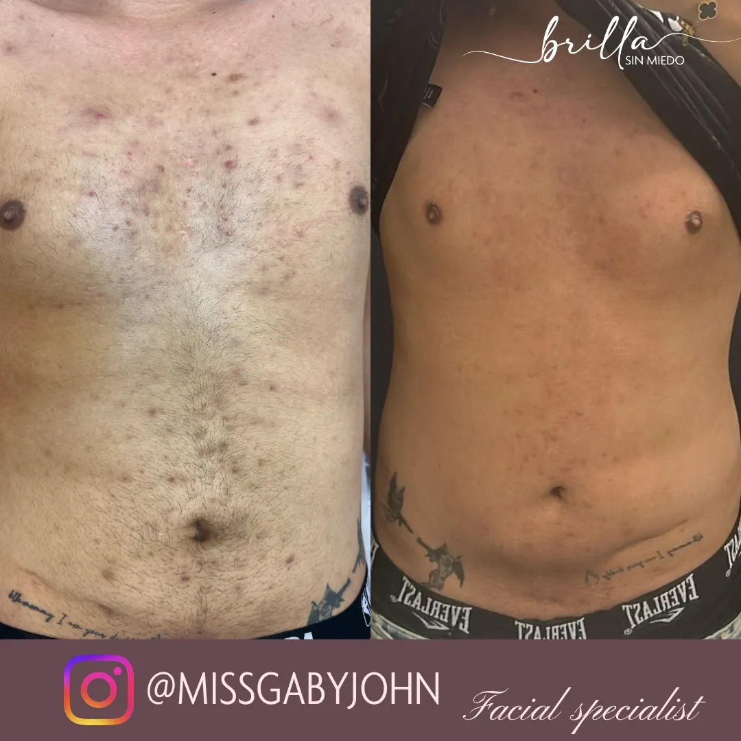 Antes y después: Peeling Facial y Corporal en Brilla Sin Miedo, caso 3