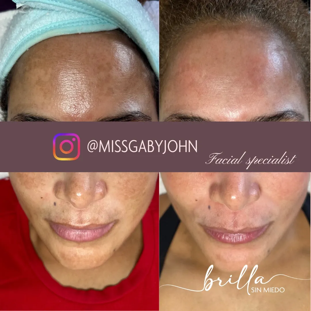 Antes y después: Tratamiento de Melasma en Brilla Sin Miedo, caso 1