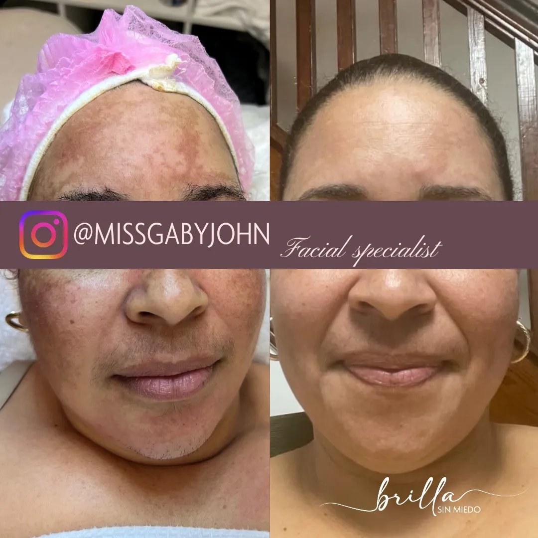 Antes y después: Tratamiento de Melasma en Brilla Sin Miedo, caso 2