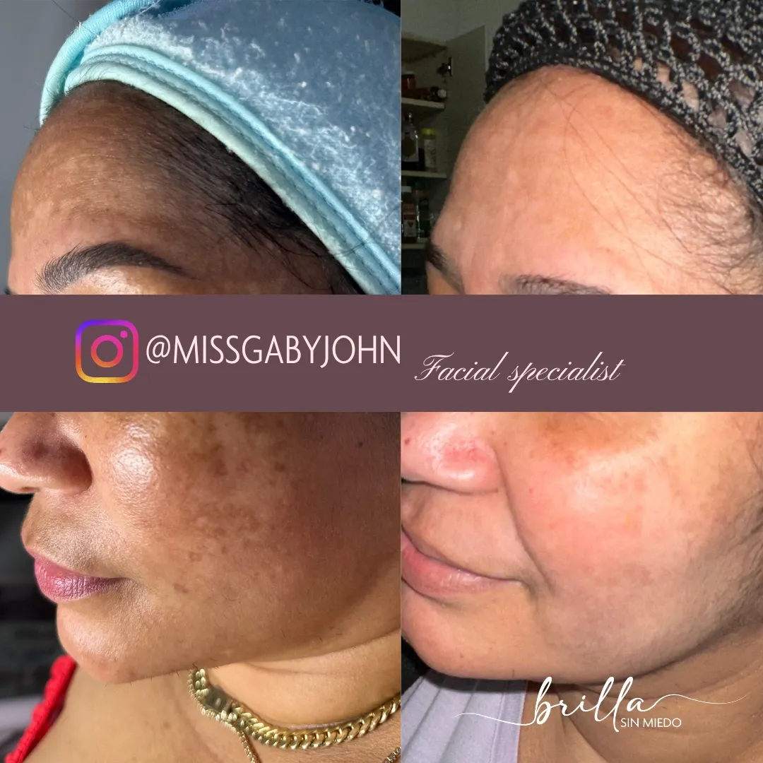 Antes y después: Tratamiento de Melasma en Brilla Sin Miedo, caso 3