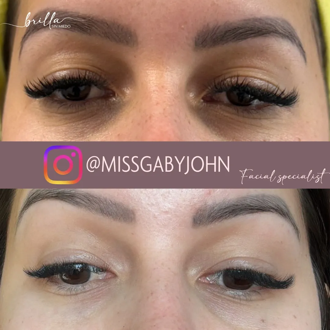 Antes y después: Tratamiento para Ojeras en Brilla Sin Miedo, caso 1