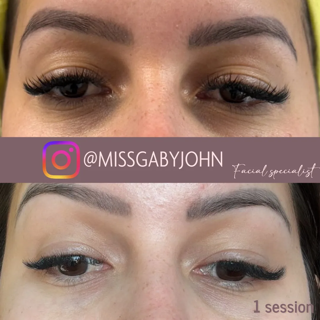 Antes y después: Tratamiento para Ojeras en Brilla Sin Miedo, caso 1