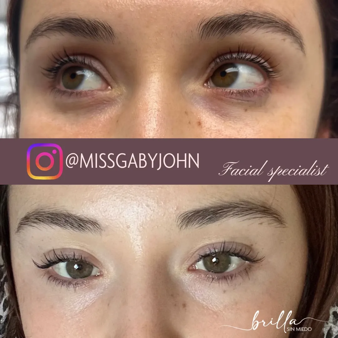 Antes y después: Tratamiento para Ojeras en Brilla Sin Miedo, caso 2