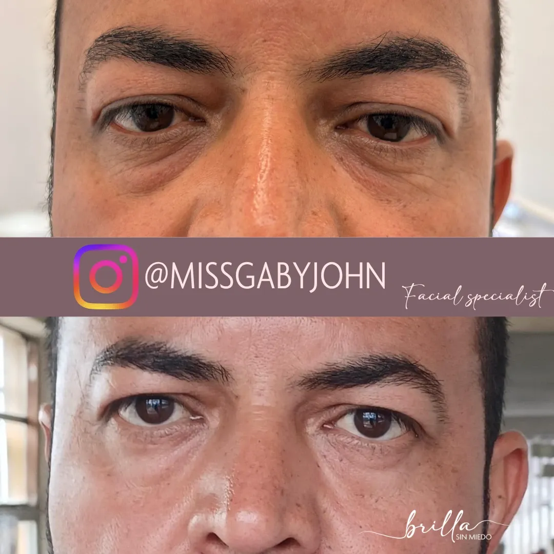 Antes y después: Tratamiento para Ojeras en Brilla Sin Miedo, caso 3
